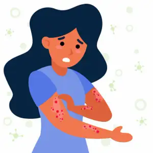 Eczema